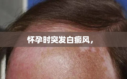 怀孕时突发白癜风,