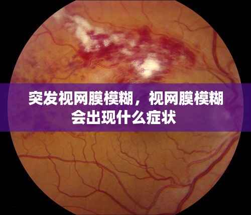 突发视网膜模糊，视网膜模糊会出现什么症状 